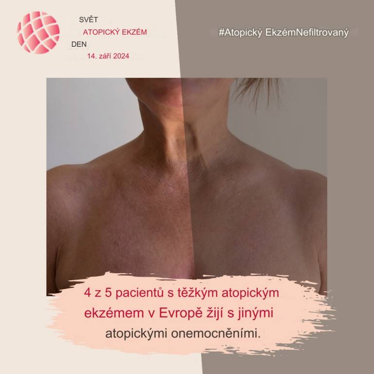 Světový den atopického ekzému 2024